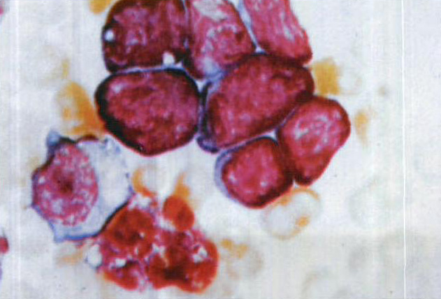 图4-13 淋巴肉瘤骨髓像